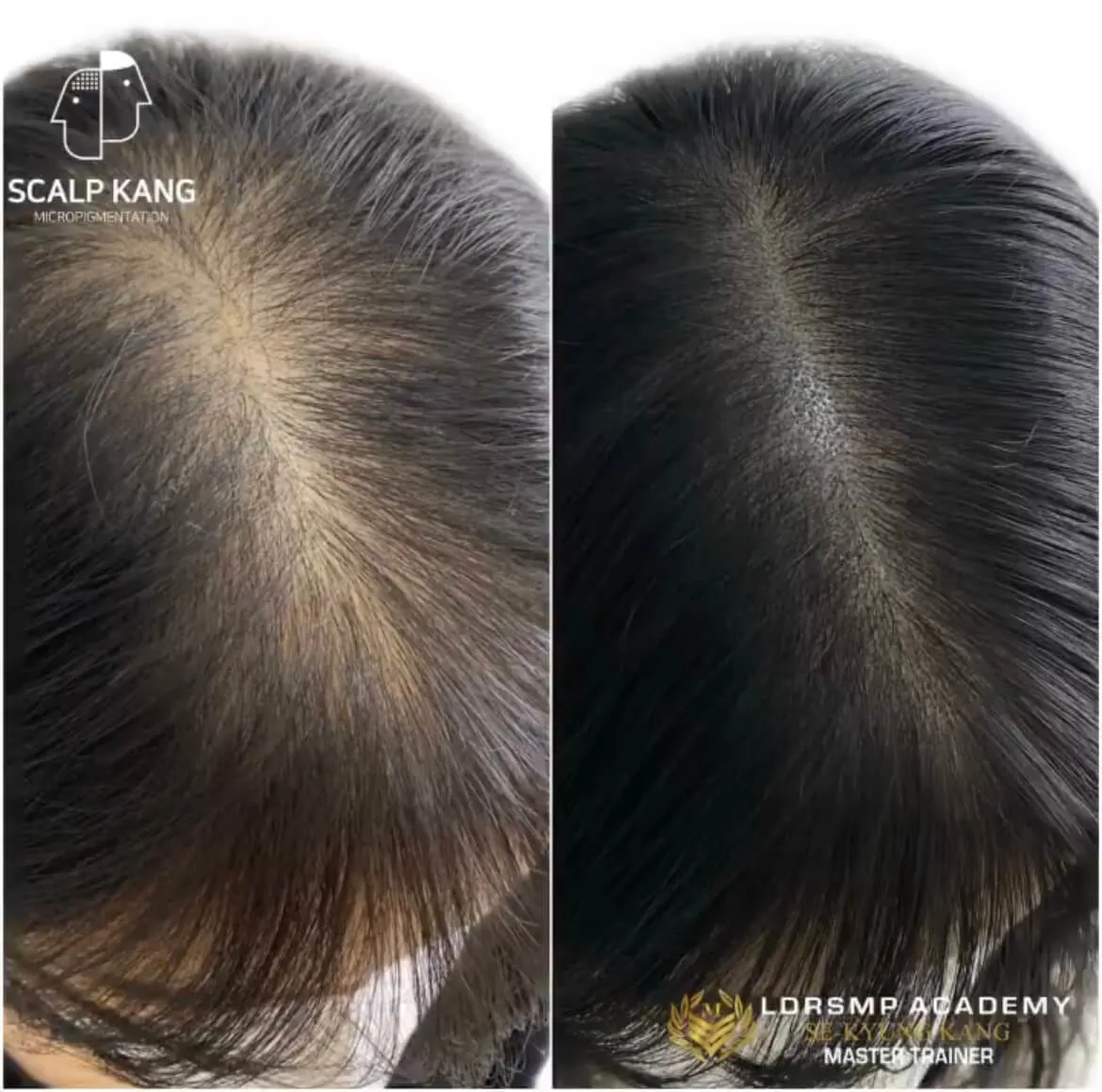 woman hair loss scalp micropigmentation training smp training