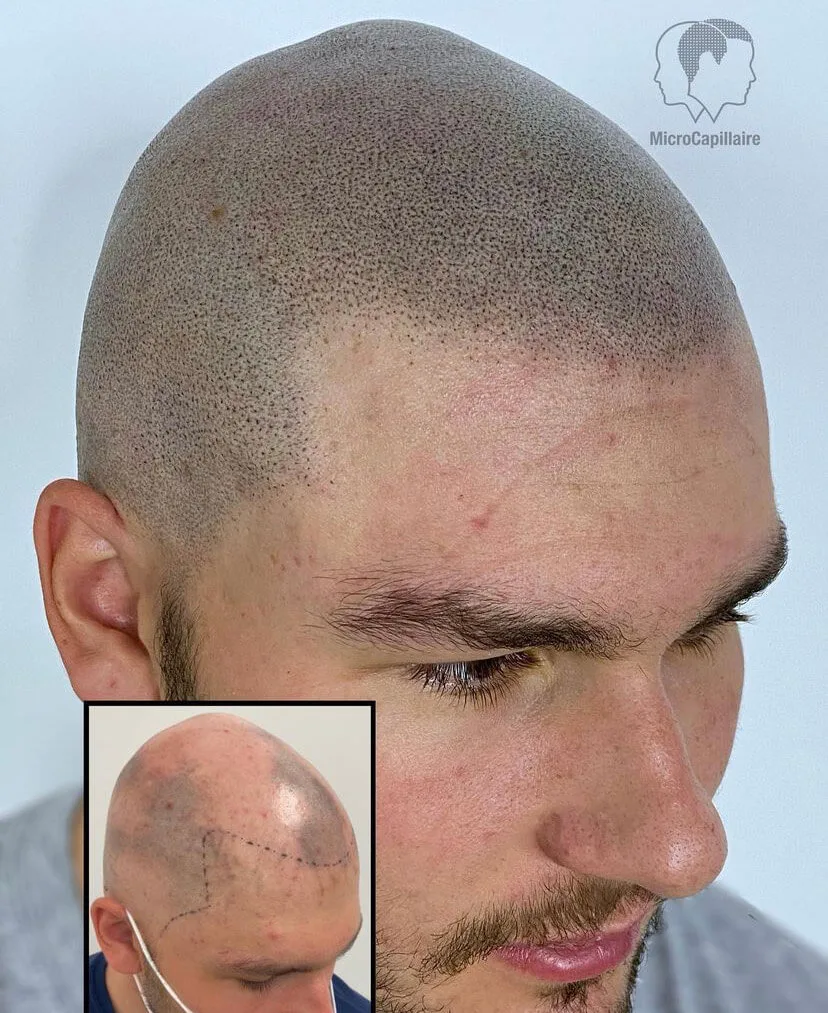 LDRSMP Academy - Scalp Micropigmentation Training - SMP Training - Austin texas - los angels - chicago - ohio - korea -new york - montereal - toronto