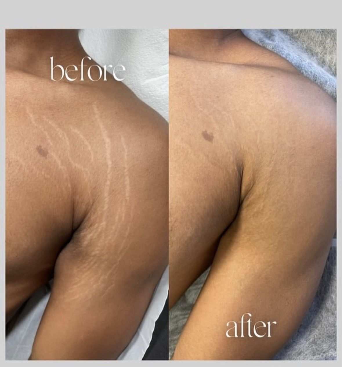 SCAR REJUVENATION