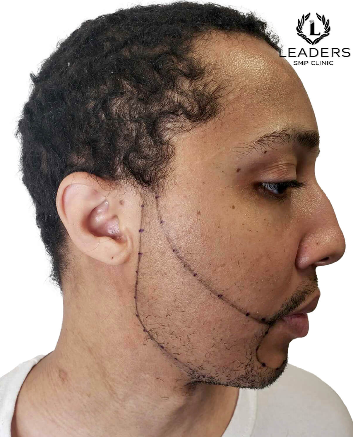 Leaders SMP Clinic scalp micropigmentation Beard Enhancement.2