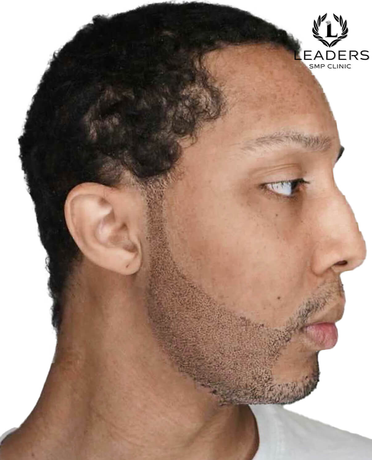 Leaders SMP Clinic scalp micropigmentation Beard Enhancement