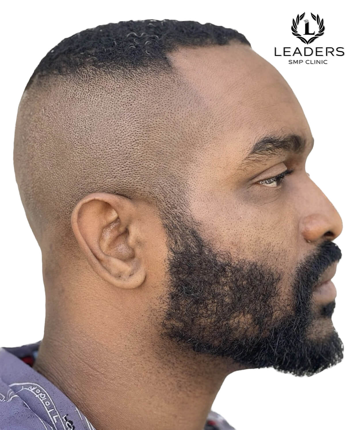 Leaders SMP Clinic scalp micropigmentation alopecia.2