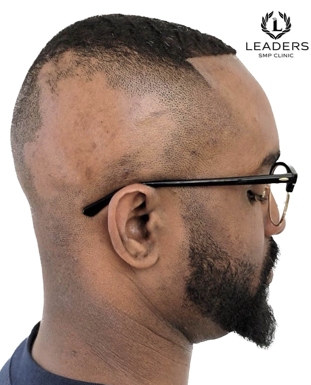 Leaders SMP Clinic scalp micropigmentation alopecia