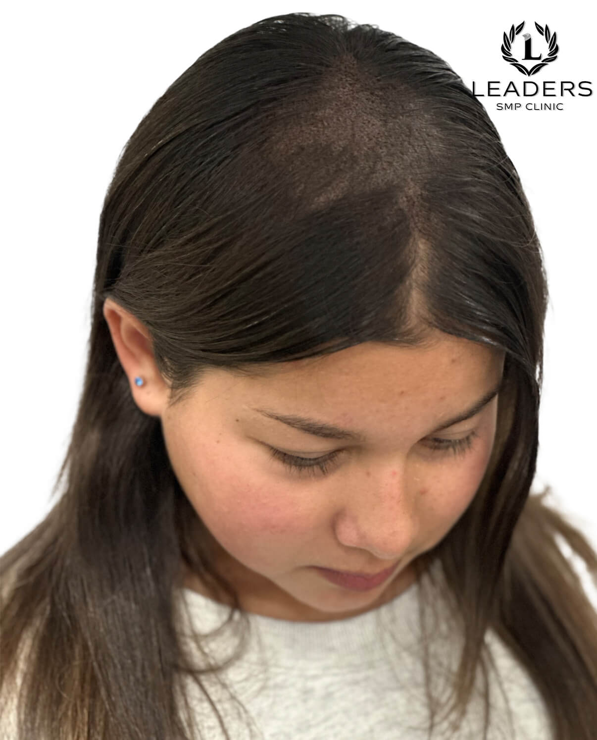 Leaders SMP Clinic scalp micropigmentation female hair loss.2