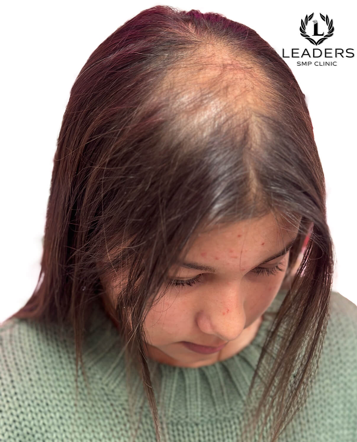 Leaders SMP Clinic scalp micropigmentation female hair loss