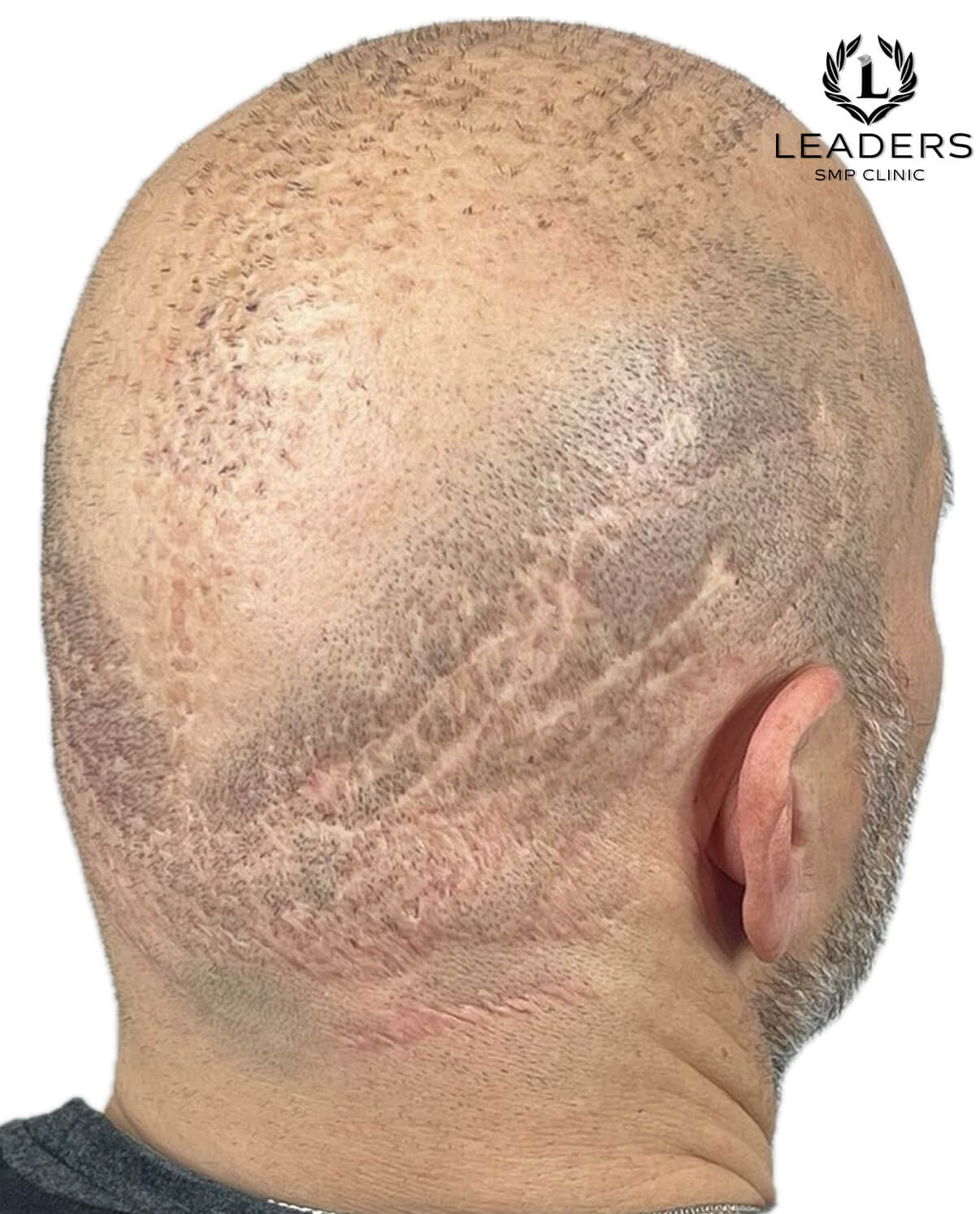 Leaders SMP Clinic scalp micropigmentation scar camouflage.2