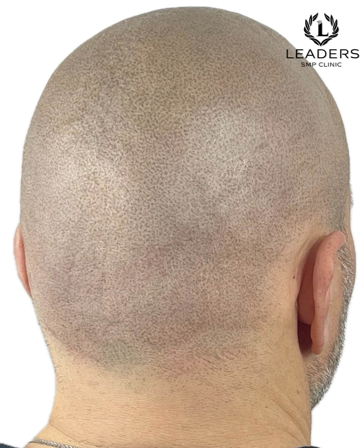 Leaders SMP Clinic scalp micropigmentation scar camouflage