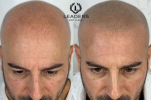 Scalp Micropigmentation Classes