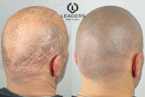 Scalp Micropigmentation Academy in Mansfield