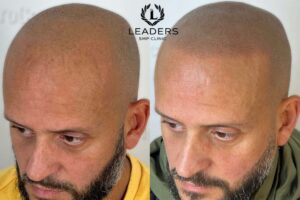 Scalp Micropigmentation Training