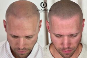 Montreal Scalp Micropigmentation Certification