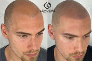 Montreal Scalp Micropigmentation Certification