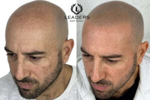 scalp micropigmentation online training