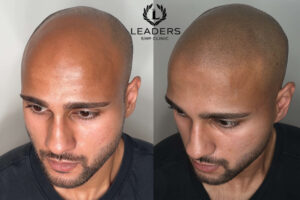 Top Scalp Micropigmentation Training