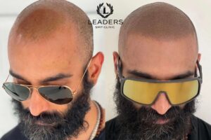 Leaders SMP Clinic - scalp - micropigmentation - smp 42