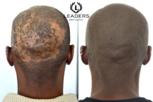 Leaders SMP Clinic - scalp - micropigmentation - smp 54