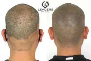 Leaders SMP Clinic - scalp - micropigmentation - smp 55