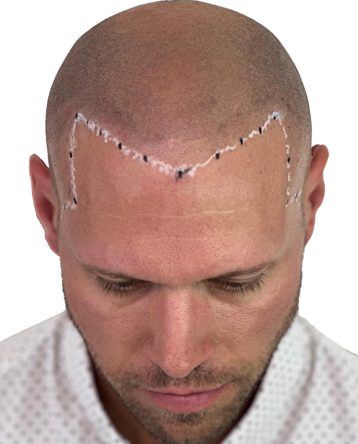 Leaders SMP Clinic scalp micropigmentation smp 65