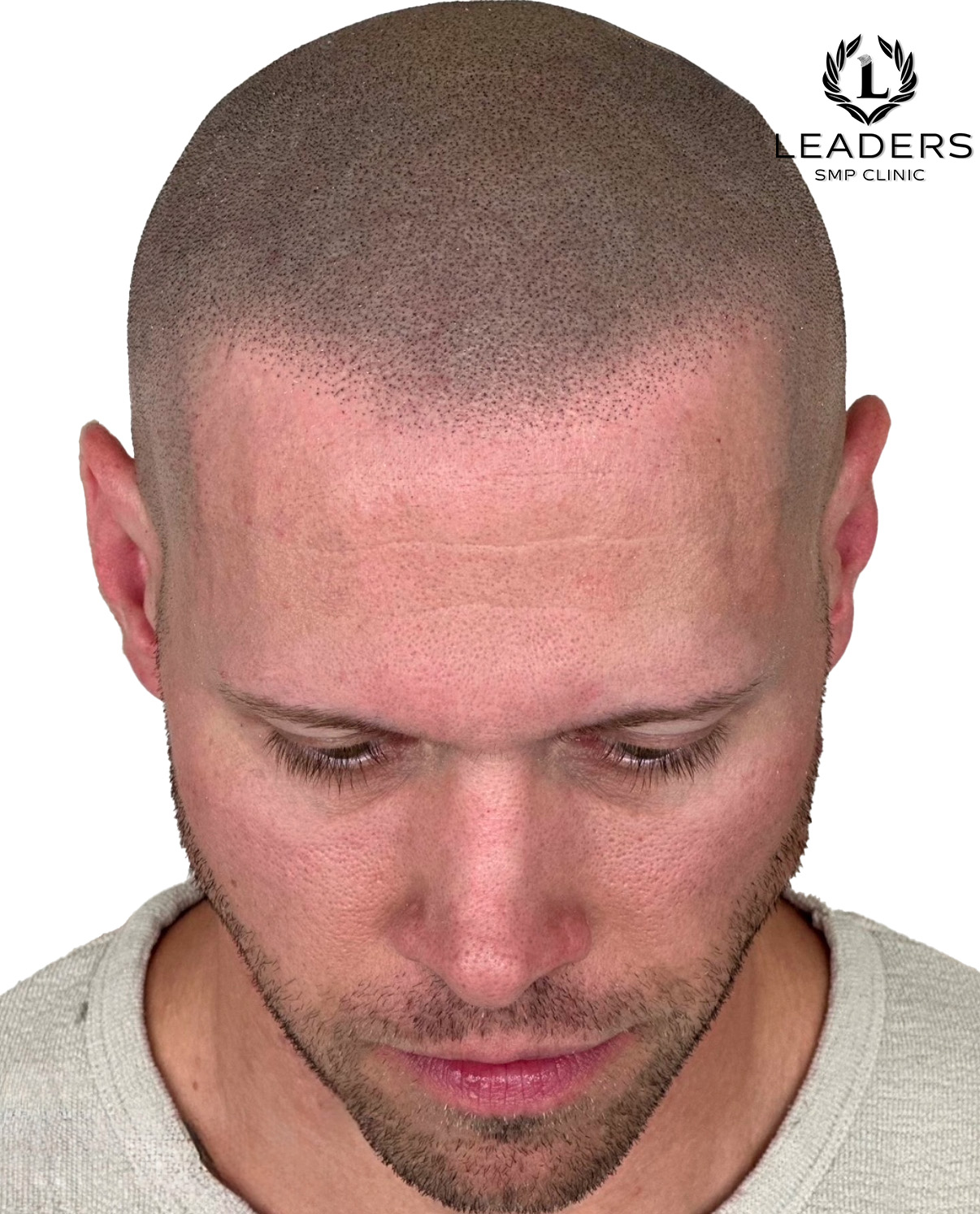 Leaders SMP Clinic scalp micropigmentation smp 66