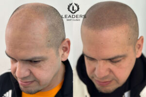 Scalp Micropigmentation Academy in Las Vegas