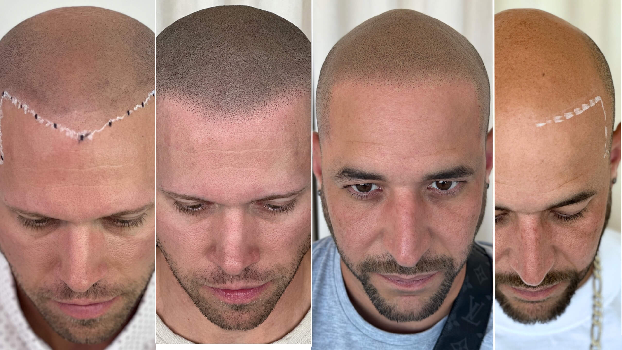 Leaders SMP Clinic -what - is - scalp - micropigmentation - smp